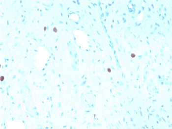 IHC staining of FFPE human cervix with recombinant HPV16 L1 antibody (clone rHPV16L1/1058). Required HIER: boil tissue sections in pH6, 10mM citrate buffer, for 10-20 min followed by cooling at RT for 20 min.