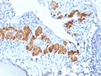 IHC testing of FFPE human breast carcinoma with recombinant SMMHC antibody (clone MYH11/2303R). Required HIER: boil tissue sections in pH 9 10mM Tris with 1mM EDTA for 10-20 min followed by cooling at RT for 20 min.