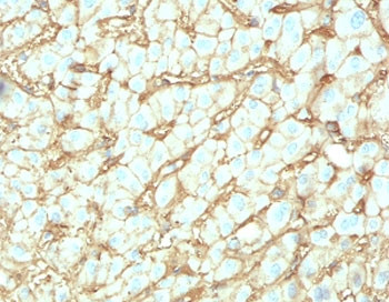 IHC testing of FFPE human hepatocellular carcinoma with Albumin antibody (clone ABMN-1). Required HIER: boil tissue sections in 10mM citrate buffer, pH6, for 10-20 min followed by cooling at RT for 20 min.