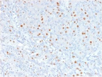 IHC testing of FFPE human bladder carinoma with Annexin A1 antibody (clone 6E4/3). HIER: boil tissue sections in pH6, 10mM citrate buffer, for 10-20 min followed by cooling at RT for 20 min.