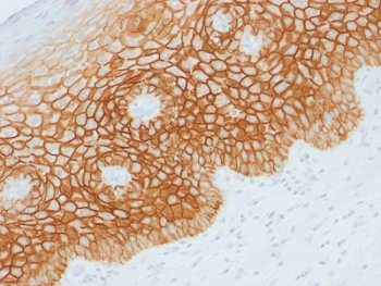 IHC testing of FFPE human cervical squamos cell carcinoma with CD44v4 antibody. Required HIER: steam sections in pH 9 10mM Tris with 1mM EDTA buffer for 10-20 min.