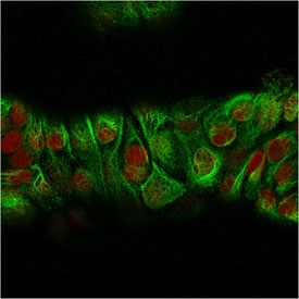IHC testing of FFPE human prostate cancer with recombinant Basic Cytokeratin antibody (clone KRTH/2147R). Required HIER: boil tissue sections in 10mM citrate buffer, pH 6, for 10-20 min followed by cooling at RT for 20 min.