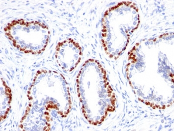 IHC testing of FFPE human prostate cancer with recombinant p63 antibody (clone TP63/1423R). Required HIER: boil tissue sections in pH 9 10mM Tris with 1mM EDTA for 10-20 min followed by cooling at RT for 20 min.