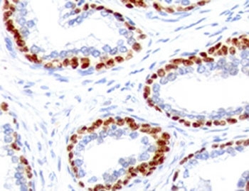 IHC testing of FFPE human prostate cancer with recombinant p63 antibody (clone TMPR63-1R). Required HIER: boil tissue sections in pH 9 10mM Tris with 1mM EDTA for 10-20 min followed by cooling at RT for 20 min.