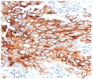 IHC testing of FFPE human lung mesothelioma with MSLN antibody (clone MKPF-1). HIER: boil tissue sections in pH 9 10mM Tris with 1mM EDTA for 10-20 min followed by cooling at RT for 20 min.