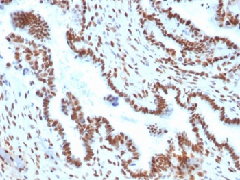 IHC testing of FFPE human endometrial carcinoma with TLE1 antibody (clone TLE1/2051). Required HIER: boil tissue sections in pH 9 10mM Tris with 1mM EDTA for 10-20 min followed by cooling at RT for 20 min.