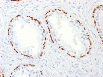 IHC testing of FFPE human prostate carcinoma with p63 antibody (clone TP63/2427). HIER: boil tissue sections in pH 9 10mM Tris with 1mM EDTA for 10-20 min followed by cooling at RT for 20 min.