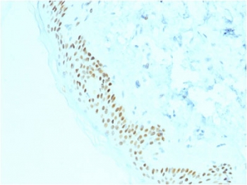 IHC testing of FFPE human basal cell carcinoma with p63 antibody (clone TP63/2428). HIER: boil tissue sections in pH 9 10mM Tris with 1mM EDTA for 10-20 min followed by cooling at RT for 20 min.