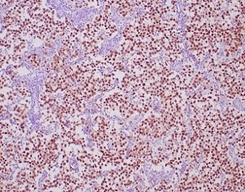 IHC staining of FFPE human seminoma tissue with OCT4 antibody (clone OCT4/6847R) at 2ug/ml. HIER: boil tissue sections in pH 9 10mM Tris with 1mM EDTA for 20 min and allow to cool before testing.