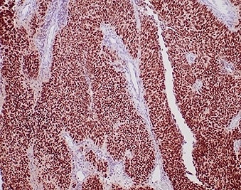 IHC staining of FFPE human urothelial carcinoma tissue with recombinant GATA Binding Protein 3 antibody (clone rGATA3/3870). HIER: boil tissue sections in pH 9 10mM Tris with 1mM EDTA for 20 min and allow to cool before testing.