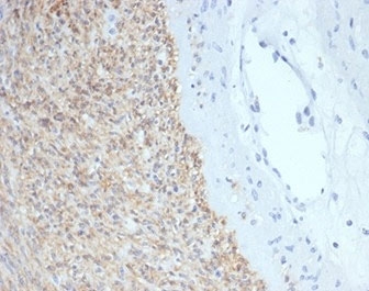 IHC staining of FFPE human gastrointestinal stromal tumor (GIST) with CD117 / SCFR antibody (clone C117/7119) at 2ug/ml. HIER: boil tissue sections in pH 9 10mM Tris with 1mM EDTA for 20 min and allow to cool before testing.