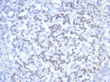IHC staining of FFPE human pancreatic cancer with PAX6 antibody (clone PAX6/7707). HIER: boil tissue sections in pH 9 10mM Tris with 1mM EDTA for 20 min and allow to cool before testing.