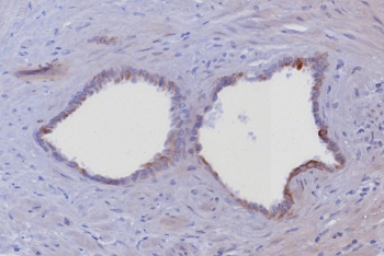 IHC staining of FFPE human prostate tissue with Cytokeratin 6 antibody (clone KRT6/8198R). HIER: boil tissue sections in pH 9 10mM Tris with 1mM EDTA for 20 min and allow to cool before testing.
