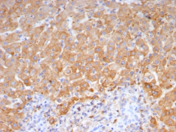 IHC staining of FFPE human hepatocellular carcinoma tissue with Haptoglobin antibody (clone HP/4815). HIER: boil tissue sections in pH 9 10mM Tris with 1mM EDTA for 20 min and allow to cool before testing.