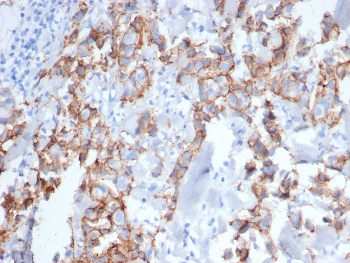 IHC staining of FFPE human breast carcinoma tissue stained with ErbB2 antibody (clone ERBB2/6637) at 2ug/ml. HIER: boil tissue sections in pH 9 10mM Tris with 1mM EDTA for 20 min and allow to cool before testing.