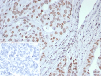 IHC staining of FFPE human ovarian cancer tissue with ARID1A antibody (clone ARID1A/7735). Inset: PBS used in place of primary Ab (secondary Ab negative control). HIER: boil tissue sections in pH 9 10mM Tris with 1mM EDTA for 20 min and allow to cool before testing.