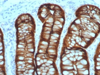 IHC staining of FFPE human colon adenocarcinoma with Villin antibody (clone VIL1/7378R). HIER: boil tissue sections in pH 9 10mM Tris with 1mM EDTA for 20 min and allow to cool before testing.