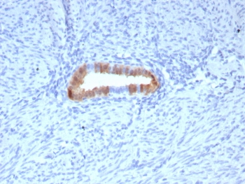 IHC staining of FFPE human cervical carcinoma tissue with P16INK4a antibody (clone rCDKN2A/8062). HIER: boil tissue sections in pH 9 10mM Tris with 1mM EDTA for 20 min and allow to cool before testing.