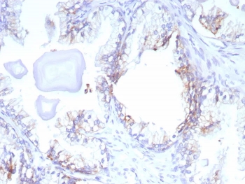 IHC staining of FFPE human prostate cancer tissue with MRP4 antibody (clone ABCC4/9179). HIER: boil tissue sections in pH 9 10mM Tris with 1mM EDTA for 20 min and allow to cool before testing.