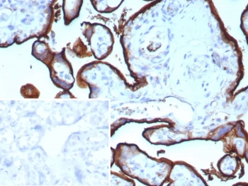 IHC staining of FFPE human placental tissue with recombinant Transferrin Receptor antibody (clone TFRC/9106R). Inset: PBS used in place of primary Ab (secondary Ab negative control). HIER: boil tissue sections in pH 9 10mM Tris with 1mM EDTA for 20 min and allow to cool before testing.