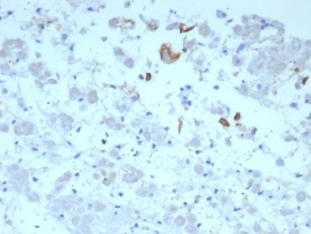 IHC staining of FFPE human adrenal gland tissue with IL-6 antibody (clone IL6/8713). HIER: boil tissue sections in pH 9 10mM Tris with 1mM EDTA for 20 min and allow to cool before testing.