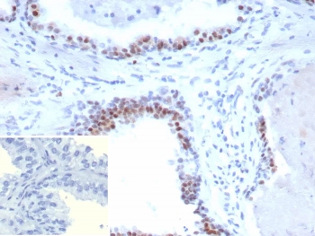 IHC staining of FFPE human prostate carcinoma tissue with recombinant Androgen Receptor V7 antibody (clone DHTR.V7/9394R). HIER: boil tissue sections in pH 9 10mM Tris with 1mM EDTA for 20 min and allow to cool before testing.