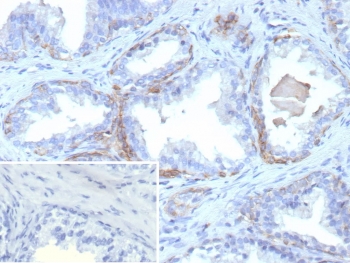 IHC staining of FFPE human prostate carcinoma tissue with recombinant KRT13 antibody (clone rKRT13/9623). Inset: PBS used in place of primary Ab (secondary Ab negative control). HIER: boil tissue sections in pH 9 10mM Tris with 1mM EDTA for 20 min and allow to cool before testing.