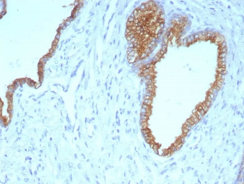 IHC staining of FFPE human prostate carcinoma tissue with CK5/6 antibody (clone KRT5.6/9104). HIER: boil tissue sections in pH 9 10mM Tris with 1mM EDTA for 20 min and allow to cool before testing.