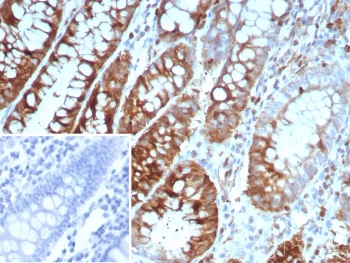 IHC staining of FFPE human colon carcinoma tissue with Oncoprotein 18 antibody (clone STMN1/8439). Inset: PBS used in place of primary Ab (secondary Ab negative control).