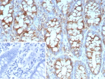 IHC staining of FFPE human colon carcinoma tissue with recombinant Stathmin 1 antibody (clone STMN1/9227R). Inset: PBS used in place of primary Ab (secondary Ab negative control). HIER: boil tissue sections in pH 9 10mM Tris with 1mM EDTA for 20 min and allow to cool before testing.