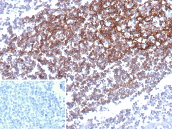 IHC staining of FFPE human prostate carcinoma with CD35 antibody (clone CD35/9444). Inset: PBS used in place of primary Ab (secondary Ab negative control). HIER: boil tissue sections in pH 9 10mM Tris with 1mM EDTA for 20 min and allow to cool before testing.