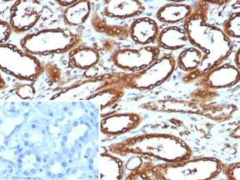 IHC staining of FFPE human renal cell carcinoma tissue with recombinant Calnexin antibody (clone CANX/9147R). Inset: PBS used in place of primary Ab (secondary Ab negative control). HIER: boil tissue sections in pH 9 10mM Tris with 1mM EDTA for 20 min and allow to cool before testing.