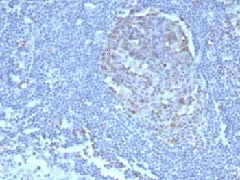 IHC staining of FFPE human tonsil tissue with Caspase 3 antibody (clone CASP3/8446). HIER: boil tissue sections in pH 9 10mM Tris with 1mM EDTA for 20 min and allow to cool before testing.