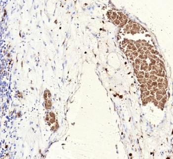 IHC staining of FFPE human Ewing Sarcoma tissue with recombinant Fli1 antibody (clone rFLI1/9614). HIER: boil tissue sections in pH 9 10mM Tris with 1mM EDTA for 20 min and allow to cool before testing.