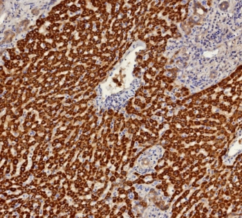 IHC staining of FFPE human hepatocellular carcinoma tissue with AKR1C1 antibody (clone AKR1C1/9314). HIER: boil tissue sections in pH 9 10mM Tris with 1mM EDTA for 20 min and allow to cool before testing.