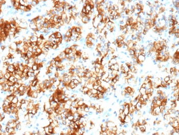 IHC staining of FFPE human renal cell carcinoma tissue with recombinant Carbonic Anhydrase 9 antibody (clone rPN-15). HIER: boil tissue sections in pH 9 10mM Tris with 1mM EDTA for 20 min and allow to cool before testing.