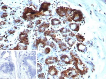 IHC staining of FFPE human breast carcinoma tissue with recombinant BRCA1-Associated Protein 1 antibody (clone BAP1/9120R). Inset: PBS used in place of primary Ab (secondary Ab negative control). HIER: boil tissue sections in pH 9 10mM Tris with 1mM EDTA for 20 min and allow to cool before testing.