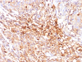 IHC staining of FFPE triple negative breast cancer tissue with MRP8 antibody (clone ABCC11/2438). HIER: boil tissue sections in pH 9 10mM Tris with 1mM EDTA for 20 min and allow to cool before testing.
