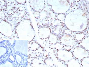 IHC staining of FFPE human prostate carcinoma tissue with FOXP1 antibody (clone FOXP1/9381R). Inset: PBS used in place of primary Ab (secondary Ab negative control). HIER: boil tissue sections in pH 9 10mM Tris with 1mM EDTA for 20 min and allow to cool before testing.