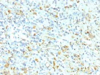IHC staining of FFPE human Ewing Sarcoma tissue with recombinant Anaplastic Lymphoma Kinaseantibody (clone ALK1/9660R). HIER: boil tissue sections in pH 9 10mM Tris with 1mM EDTA for 20 min and allow to cool before testing.