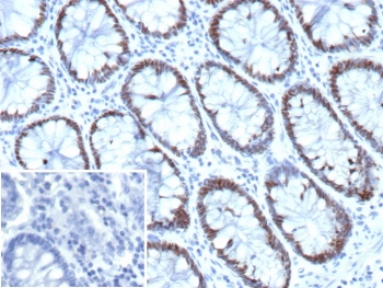 IHC staining of FFPE human colon tissue with Caudal type homeobox transcription factor 2 antibody (clone CDX2/9338). Inset: PBS used in place of primary Ab (secondary Ab negative control). HIER: boil tissue sections in pH 9 10mM Tris with 1mM EDTA for 20 min and allow to cool before testing.