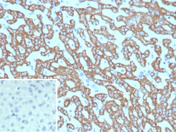 IHC staining of FFPE human hepatocellular carcinoma tissue with Carbamoyl phosphate synthetase 1 antibody (clone CPS1/9865). Inset: PBS used in place of primary Ab (secondary Ab negative control). HIER: boil tissue sections in pH 9 10mM Tris with 1mM EDTA for 20 min and allow to cool before testing.