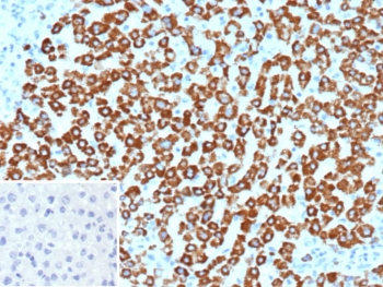 IHC staining of FFPE human hepatocellular carcinoma tissue with Carbamoyl phosphate synthetase 1 antibody (clone CPS1/9867). Inset: PBS used in place of primary Ab (secondary Ab negative control). HIER: boil tissue sections in pH 9 10mM Tris with 1mM EDTA for 20 min and allow to cool before testing.