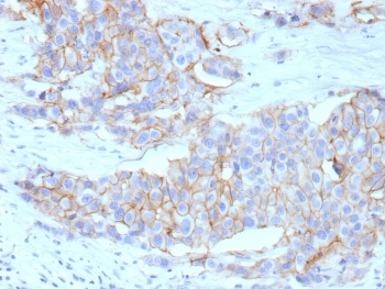 IHC staining of FFPE human breast cancer tissue with recombinant HER-2 antibody (clone ERBB2/13055R). Inset: PBS used in place of primary Ab (secondary Ab negative control). HIER: boil tissue sections in pH 9 10mM Tris with 1mM EDTA for 20 min and allow to cool before testing.
