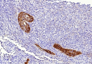 IHC staining of FFPE human lung tissue with Tissue Factor antibody (clone CD142/9196). HIER: boil tissue sections in pH 9 10mM Tris with 1mM EDTA for 20 min and allow to cool before testing.