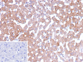 IHC staining of FFPE human hepatocellular carcinoma tissue with 17-beta-hydroxysteroid dehydrogenase 13 antibody (clone HSD17B13/13109). Inset: PBS used in place of primary Ab (secondary Ab negative control). HIER: boil tissue sections in pH 9 10mM Tris with 1mM EDTA for 20 min and allow to cool before testing.