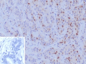 IHC staining of FFPE human breast carcinoma tissue with BRCA1 antibody (clone BRCA1/9797R). Inset: PBS used in place of primary Ab (secondary Ab negative control). HIER: boil tissue sections in pH 9 10mM Tris with 1mM EDTA for 20 min and allow to cool before testing.