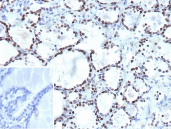 IHC staining of FFPE human thyroid tissue with NKX2.1 antibody (clone NX2.1/9033). Inset: PBS used in place of primary Ab (secondary Ab negative control). HIER: boil tissue sections in pH 9 10mM Tris with 1mM EDTA for 20 min and allow to cool before testing.