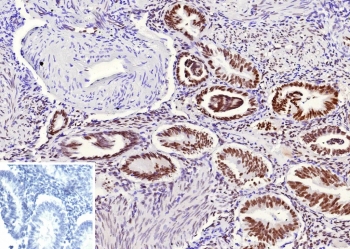 IHC staining of FFPE human endometrium tissue with recombinant TLE1 antibody (clone rTLE1/13032). Inset: PBS used in place of primary Ab (secondary Ab negative control). HIER: boil tissue sections in pH 9 10mM Tris with 1mM EDTA for 20 min and allow to cool before testing.