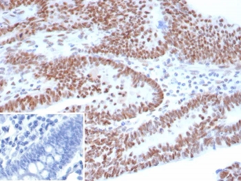 IHC staining of FFPE human ovarian carcinoma tissue with recombinant Tumor Protein 53 antibody (clone TP53/8183R). Inset: PBS used in place of primary Ab (secondary Ab negative control). HIER: boil tissue sections in pH 9 10mM Tris with 1mM EDTA for 20 min and allow to cool before testing.